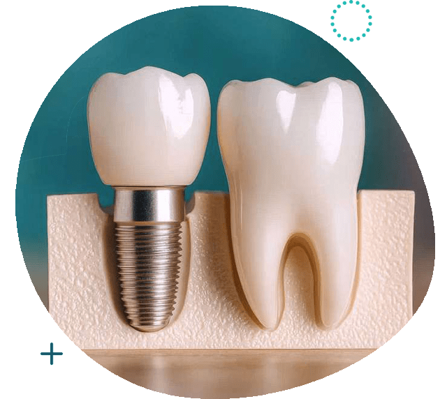Dental Implants