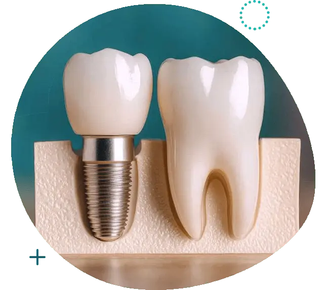 Dental Implants